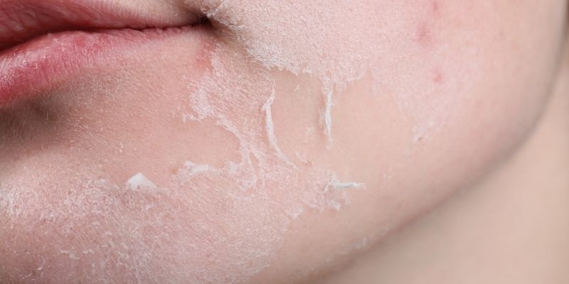 Dry Skin Explained: A Doctor Answers 5 Common Questions