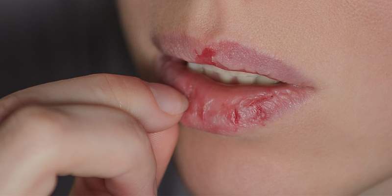 6 Best Ways To Break The Skin Picking Habit